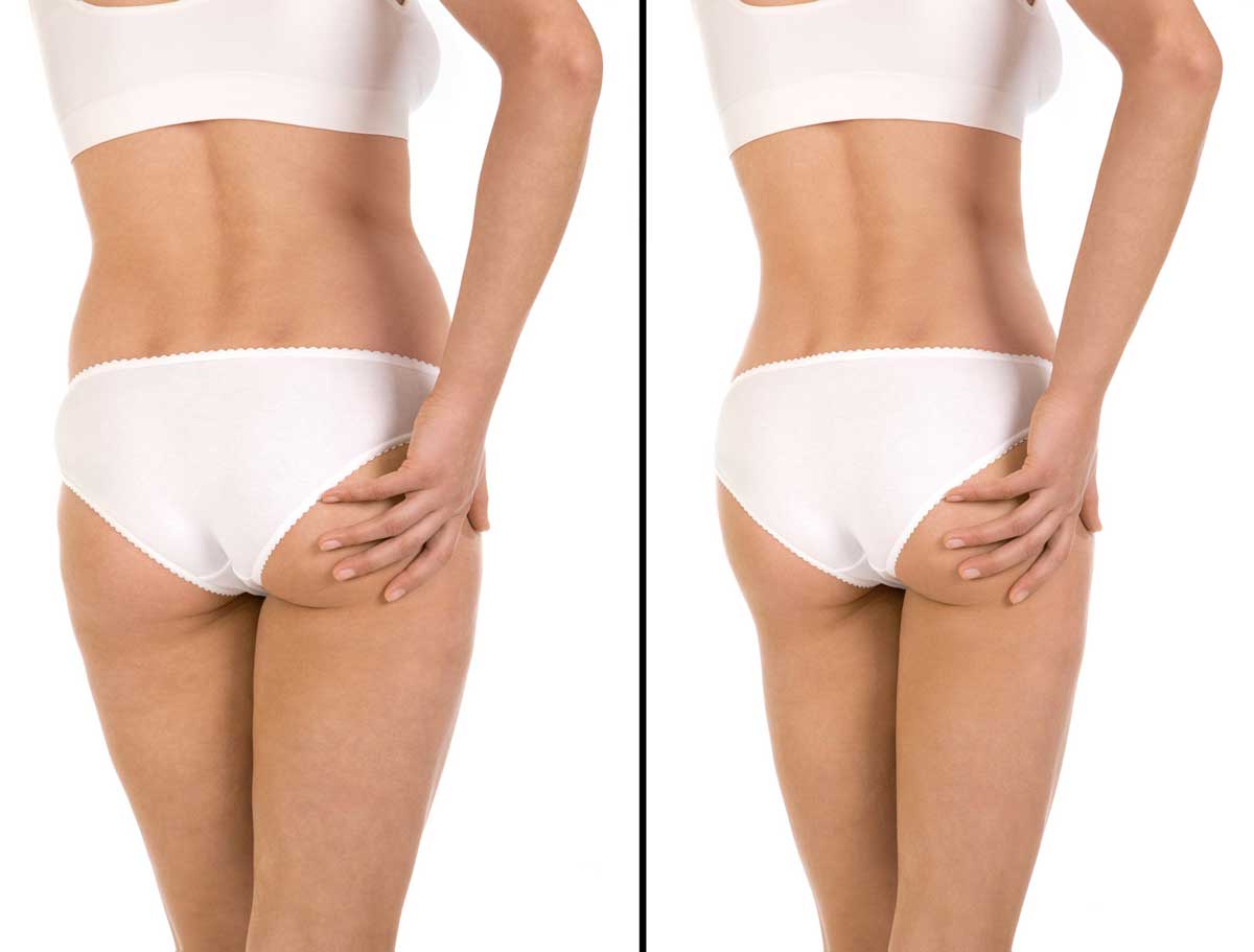 Geneviève Lecat, anti cellulite, Montigny-le-Bretonneux 